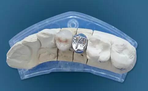 牙医怎么选最好,如何选择适合的烤瓷牙