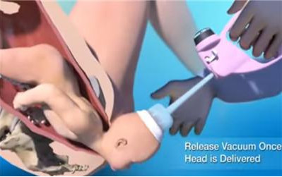 胎儿分娩用吸引器,新生儿难产负压吸引术