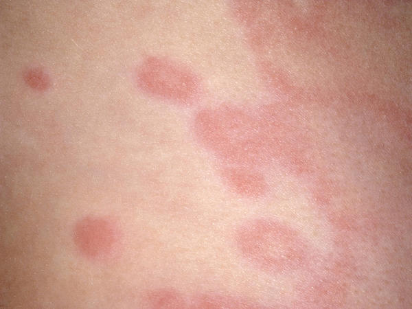 宝宝皮肤常见“痘痘”，看图学习，快点收藏起来！