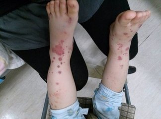 过敏性紫癜吃激素有哪些副作用,过敏性紫癜吃激素的副作用