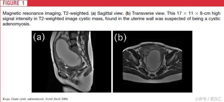 从肌瘤剔除术到全子宫切除术，一个年轻姑娘的无奈