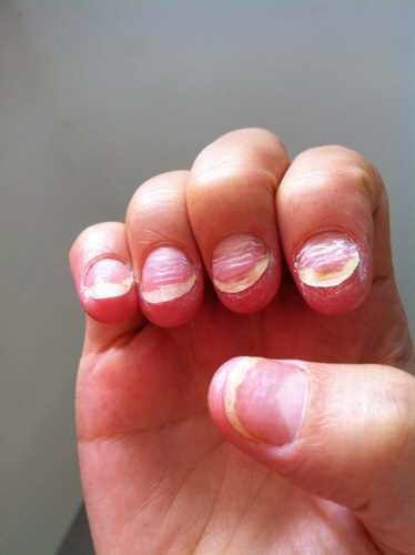 折磨我们的甲沟炎到底怎么回事？