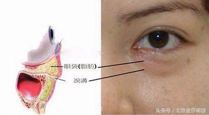 泪沟和眼袋有什么区别？预防及治疗方法有哪些？