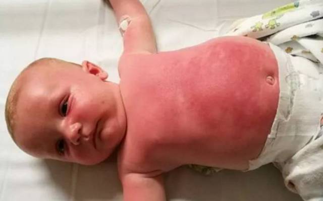 宝宝烧伤应该抹什么药膏,宝宝烧伤结痂应该抹什么药膏