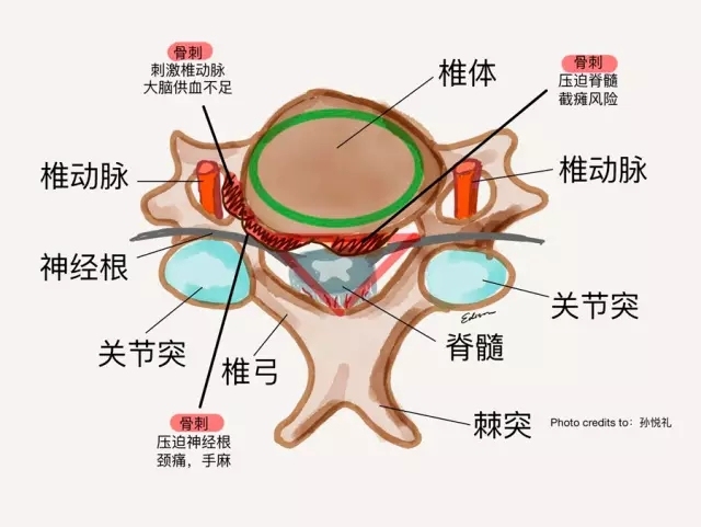 足跟痛长骨刺求治,足跟痛有骨刺能动手术吗