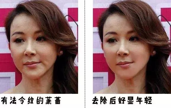 听说有法令纹的女孩子都很爱笑,爱笑的女生法令纹都不会太浅