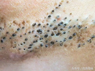 如何在家就能快速有效的去黑头,用这些方法去黑头很简单有效