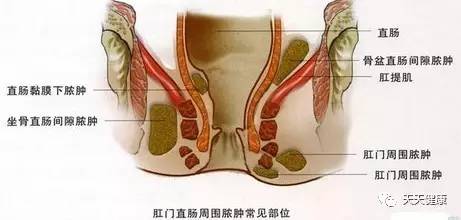 肛周脓肿快看看你中招了吗,肛周脓肿真的能保守治疗吗