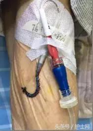 更换敷贴的操作视频,怎么换敷贴