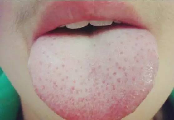 猩红热和手足口哪个可怕,小儿猩红热重型有多可怕