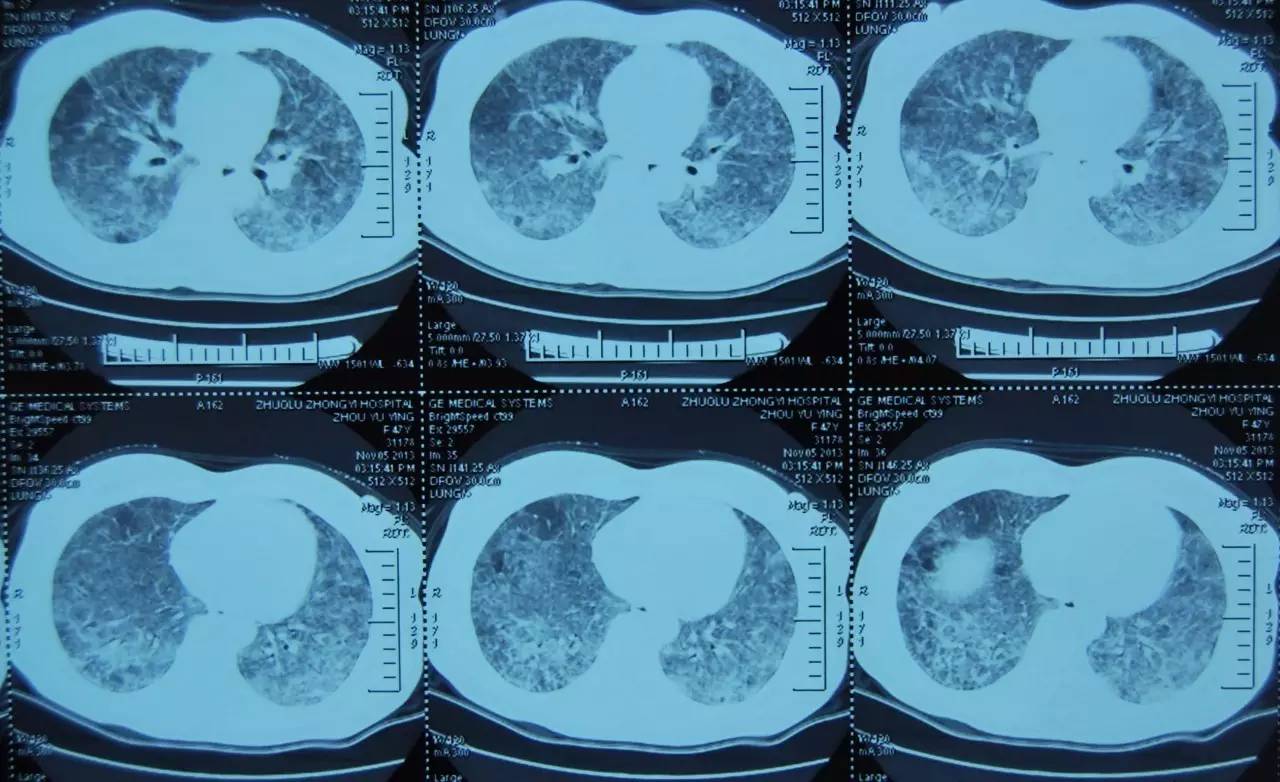 喘息、呼衰1年，问病史才发现是这个病！