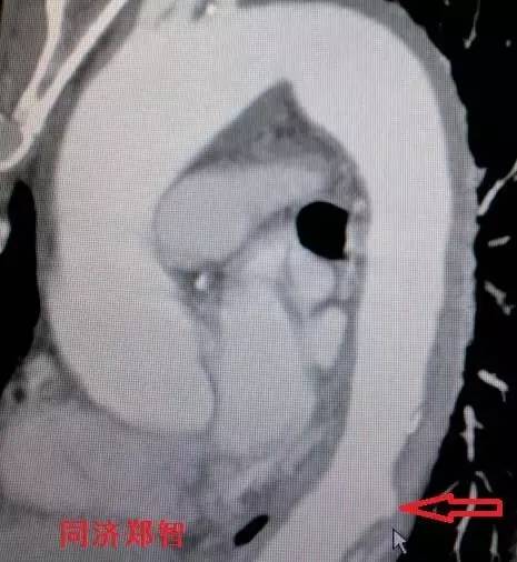 主动脉夹层差点要了老公的命,主动脉夹层兄妹
