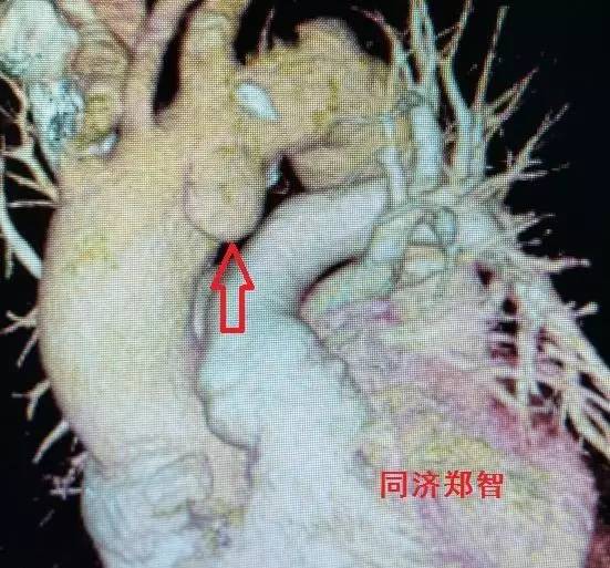 主动脉夹层差点要了老公的命,主动脉夹层兄妹