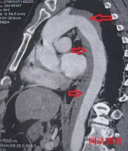 主动脉夹层差点要了老公的命,主动脉夹层兄妹