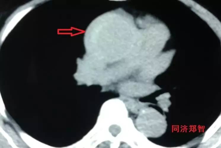 主动脉夹层差点要了老公的命,主动脉夹层兄妹