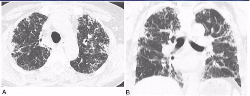 喘息、呼衰1年，问病史才发现是这个病！