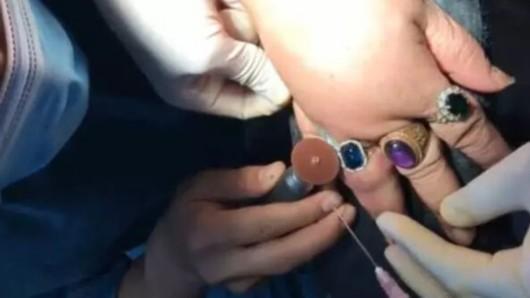 鎵嬫寚琚垝鎸囧崱浣忎簡鍘绘秷闃查槦,7鏍规墜鎸囪鎴掓寚鍗′綇