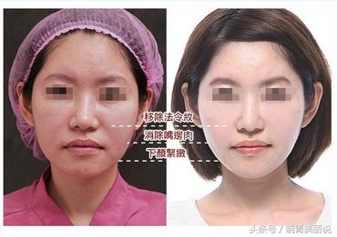 脸垮是先提拉还是填充,脸垮做什么医美没套路