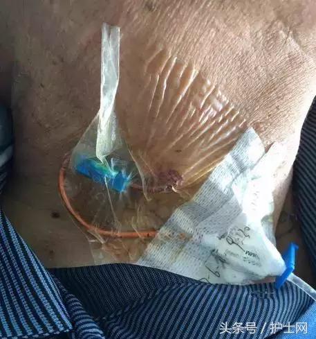 更换敷贴的操作视频,怎么换敷贴