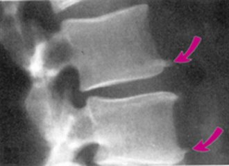 脚后跟长骨刺怎么办,膝盖长骨刺怎么办