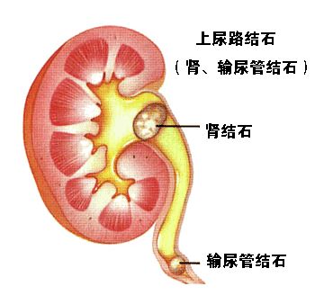 中医治疗结石病民间方子,老中医治结石病秘诀