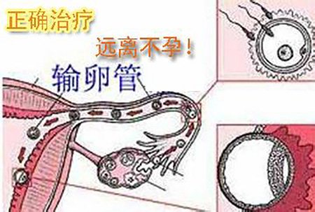 输卵管通水后更加易堵吗,输卵管堵塞通液后要注意什么