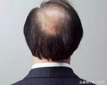 移植后的头发和正常头发有多大区别？