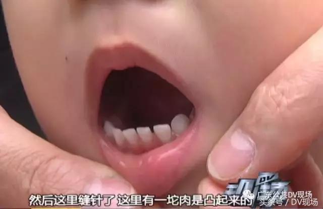 孩子玩滑滑梯摔倒怎样看情况,孩子从滑滑梯摔倒头上怎么办