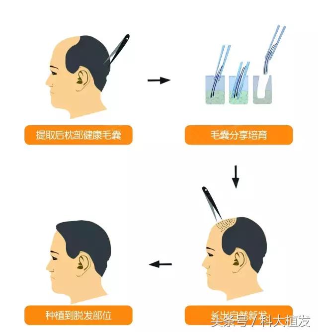 移植后的头发和正常头发有多大区别？