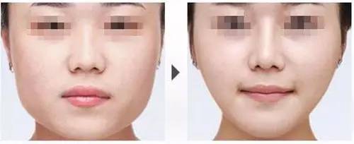 打完瘦脸针后悔了有什么办法,打完瘦脸针后悔了咋办