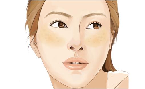 脸上长褐斑怎么快速消除,脸上大片褐斑怎么祛除