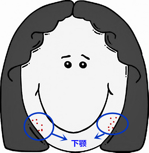 面部痘痘的症状图片和讲解,面部痘痘原因分析图片