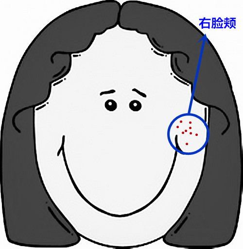 面部痘痘的症状图片和讲解,面部痘痘原因分析图片