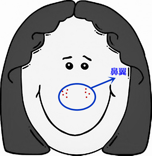 面部痘痘的症状图片和讲解,面部痘痘原因分析图片