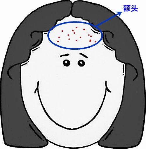 面部痘痘的症状图片和讲解,面部痘痘原因分析图片