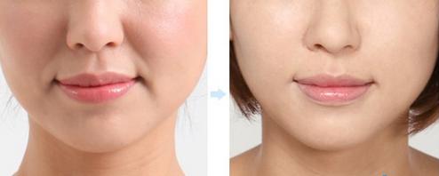 有了法令纹怎么消除,有了法令纹怎么消除的好方法