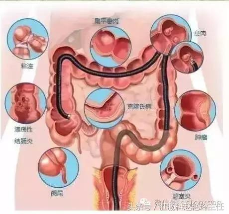 肠镜检查流程和注意事项,肠镜检查如何做