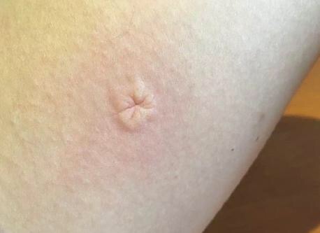 不再担心宝宝被蚊子咬了,宝宝被蚊子咬的正确处理方法