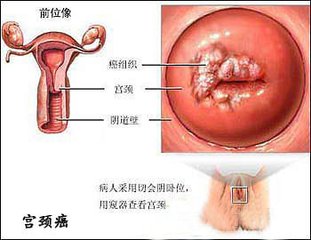 谈宫颈癌的致病“元凶”——HPV