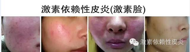 激素脸是什么病导致的,激素脸是什么症状