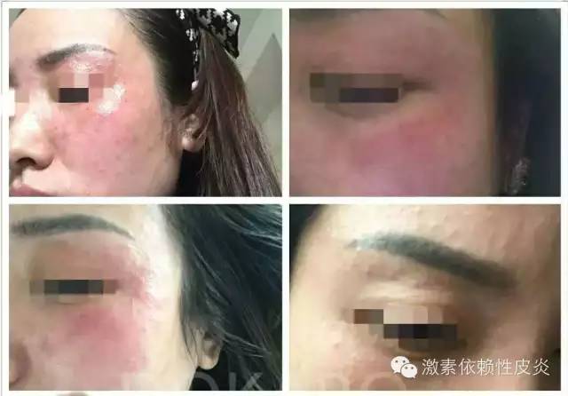 激素脸是什么病导致的,激素脸是什么症状