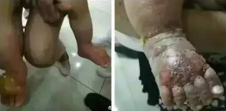 小孩子双脚皮肤溃烂,小孩腿上圆形溃烂化脓怎么回事