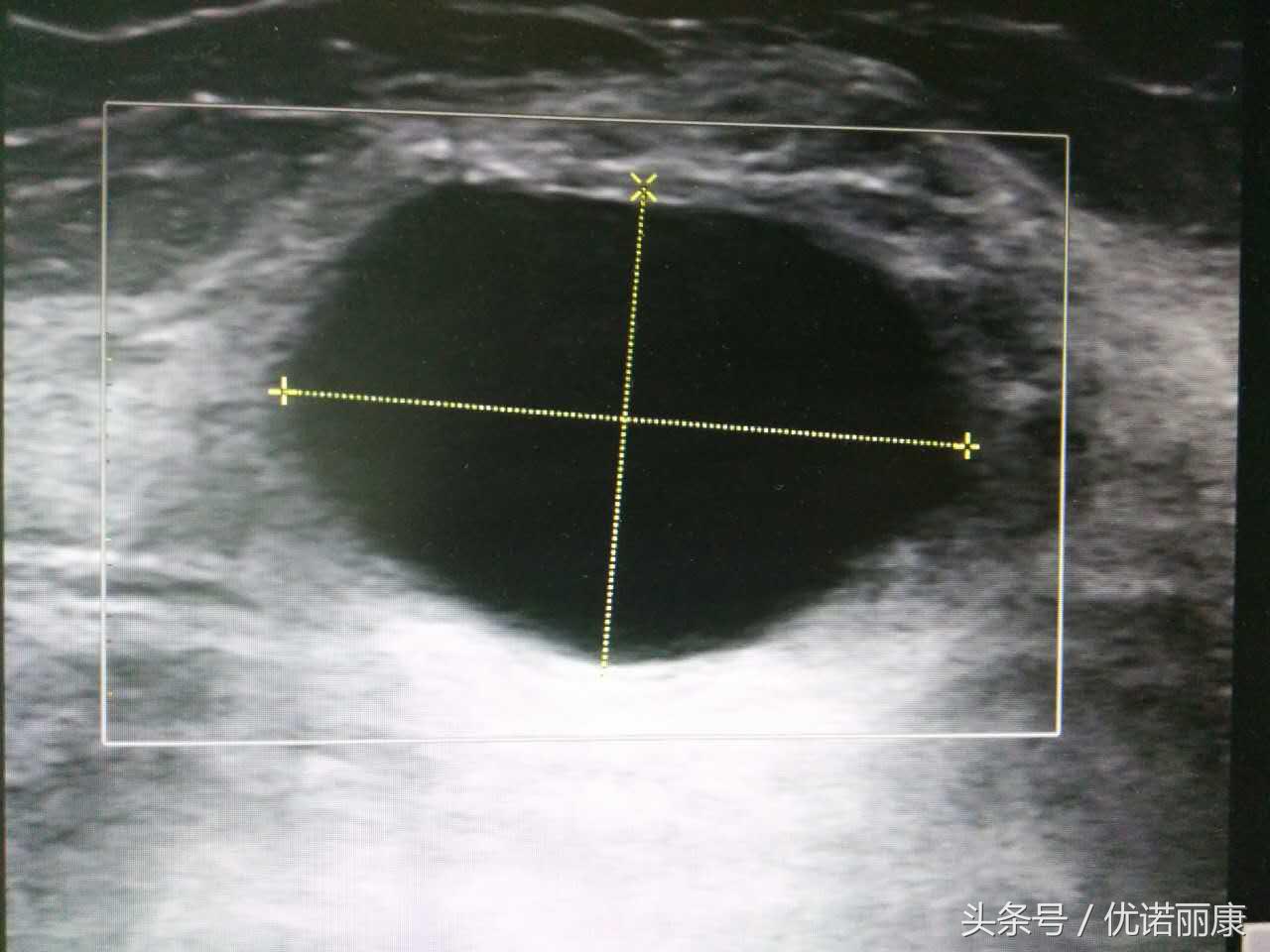 乳腺核磁共振报告专家解读,乳腺病检报告单怎么看