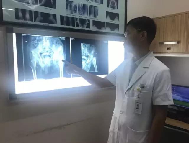 老人胯骨骨折建议手术吗,老人大胯骨折最佳手术时间