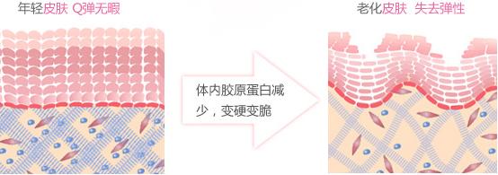 pst面部提升和拉皮手术有什么区别,内窥镜面部提升手术有什么危害