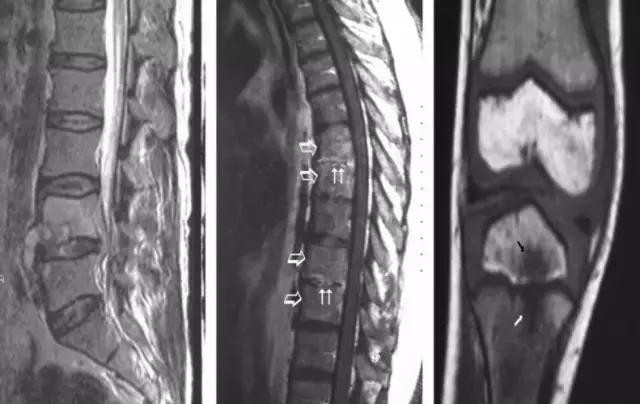 布鲁氏菌病血清学检测的方法,布鲁氏菌病是什么病怎么治疗