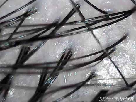 拔伤了毛囊怎么样促进毛囊生发,什么样的毛囊可以生发