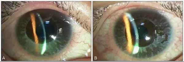 隐形眼镜的三个缺点和解决方案,隐形眼镜的这些知识你知道多少