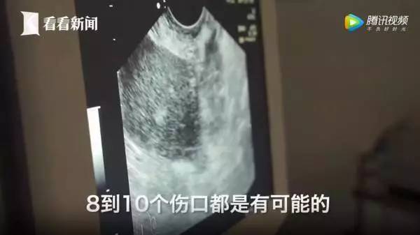 捐卵，被明码标价的青春｜关于捐卵应该知道的科普