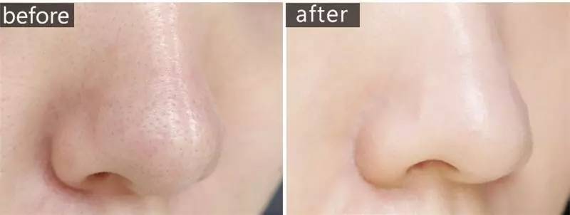 “黑头”这个渣男，彻底和他Say byebye~